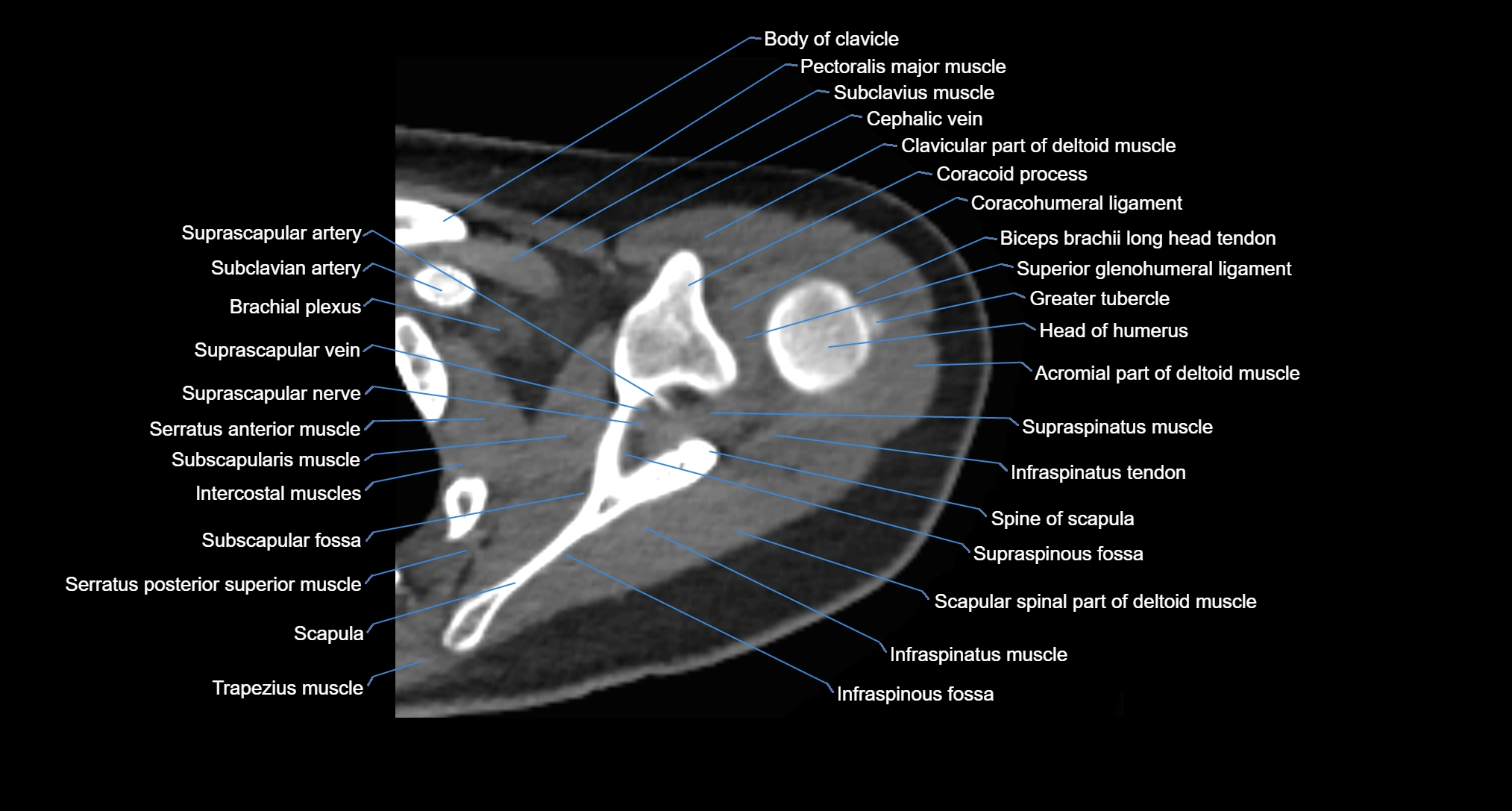 CT Shoulder axial cross sectional anatomy labelled radiology image -00024.webp